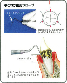 歯周病