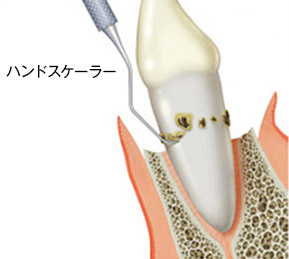 歯周病